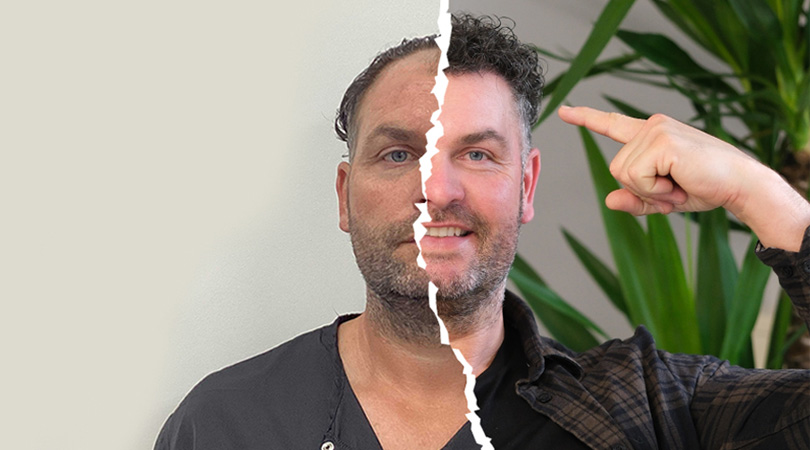 Haartransplantatie Kosten