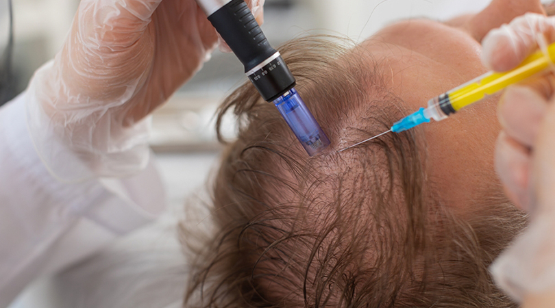Exosoombehandeling tegen Haarverlies